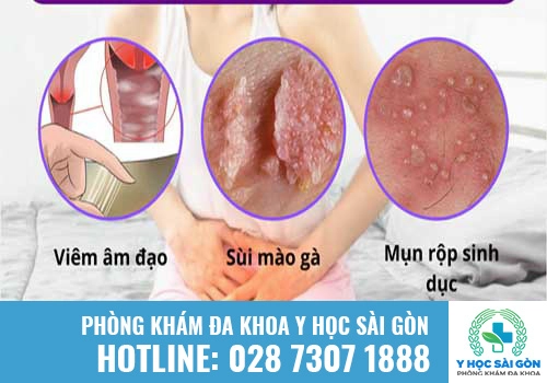 Ngứa vùng kín ở nữ giới là dấu hiệu của nhiều bệnh lý phụ khoa nguy hiểm