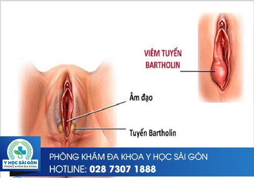 triệu chứng viêm tuyến bartholin