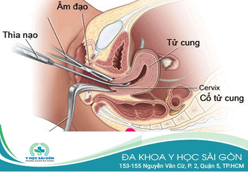 Phương pháp phá thai ngoại khoa 